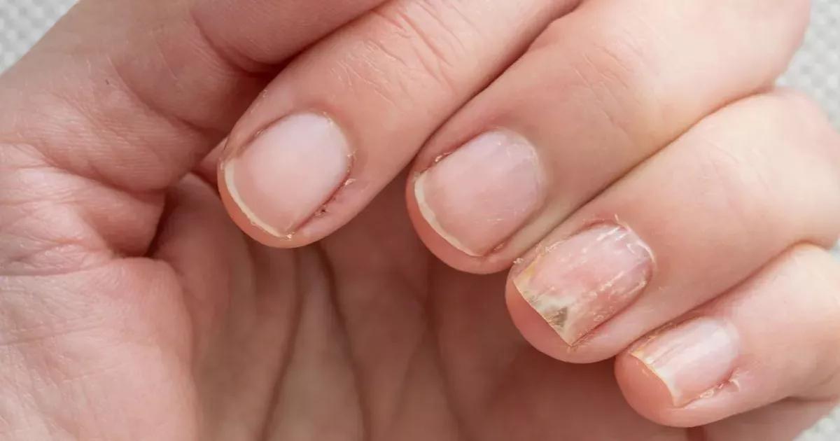 Como Curar Fungos nas Unhas com Vinagre