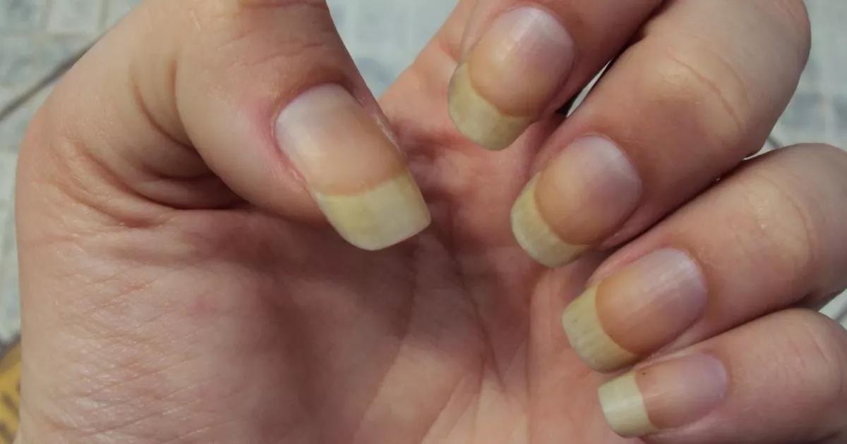 Unhas Amarelas: Descubra as Causas e Como Recuperar Suas Unhas Saudáveis e Brilhantes!