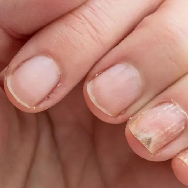 Como Curar Fungos nas Unhas com Vinagre