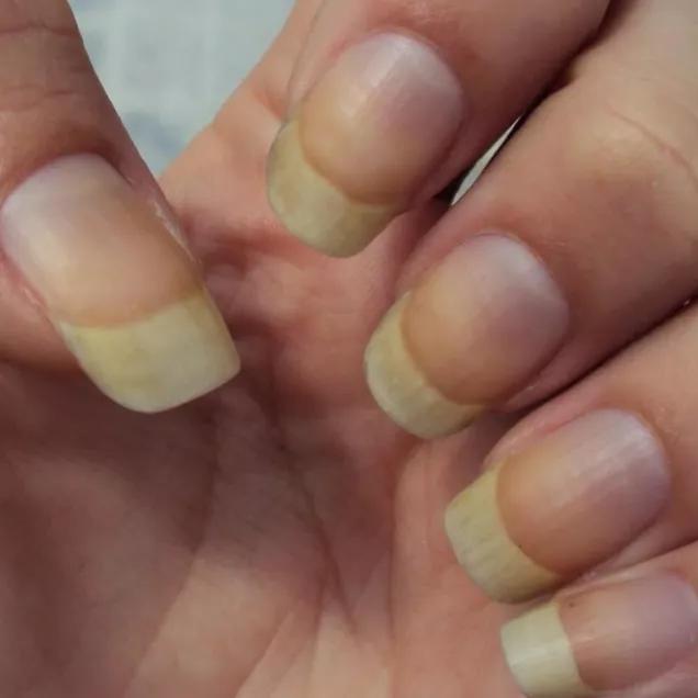 Unhas Amarelas: Descubra as Causas e Como Recuperar Suas Unhas Saudáveis e Brilhantes!