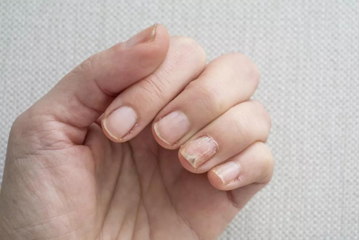 Cuidando das unhas: métodos eficazes para restaurar uma unha rachada.