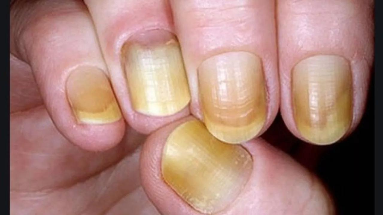 Unhas amarelas podem ser resultado do uso excessivo de esmaltes escuros sem proteção ou de infecções fúngicas.