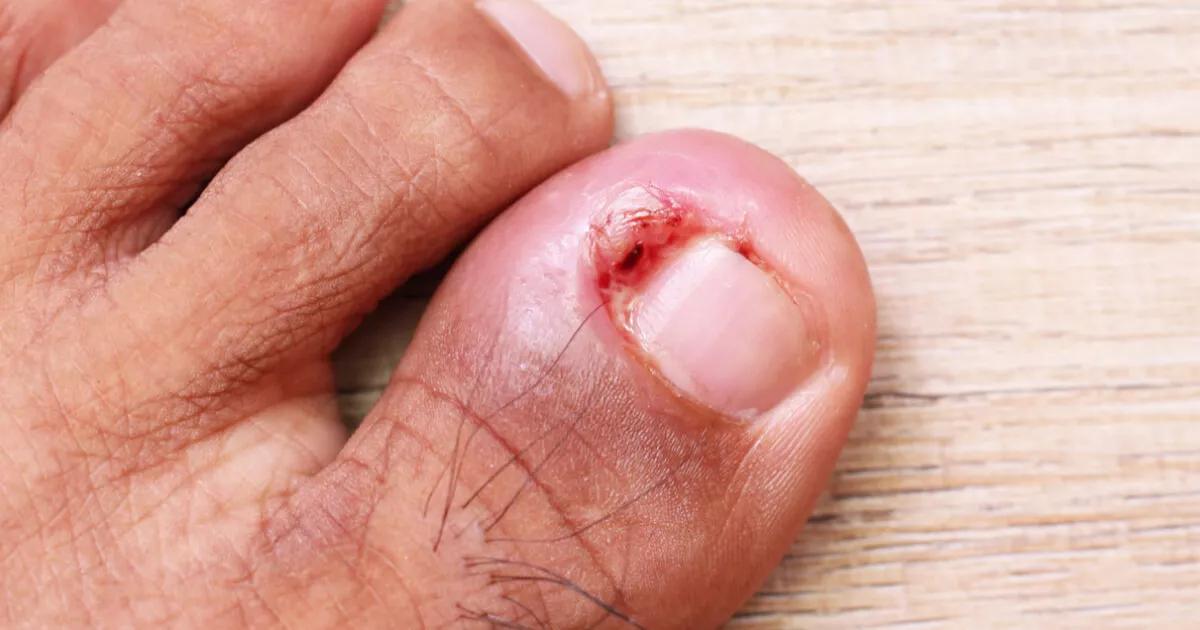 A inflamação nas unhas pode ser sinal de alguma infecção ou outro problema. Consulte um dermatologista para um diagnóstico preciso e tratamento adequado.