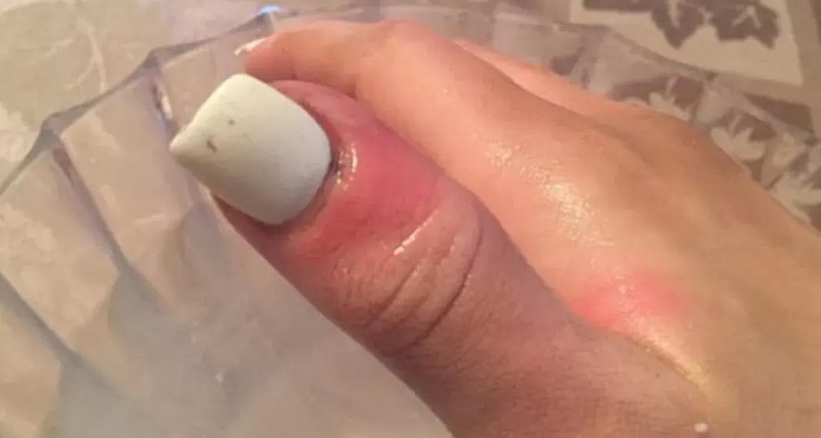 Unhas inflamadas? Não ignore esse sinal! ✋ A inflamação pode ser causada por diversos fatores e precisa de atenção médica. Procure um profissional da saúde para cuidar das suas unhas.